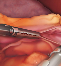 Colectomia · Cirurgia Intestinal