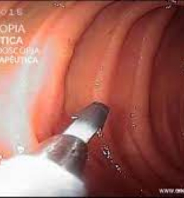 Hemostasia Endoscópica · Sangramento Digestivo