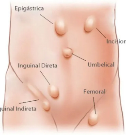 Hérnias de Parede Abdominal