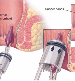 Ligadura Elástica para Hemorroidas